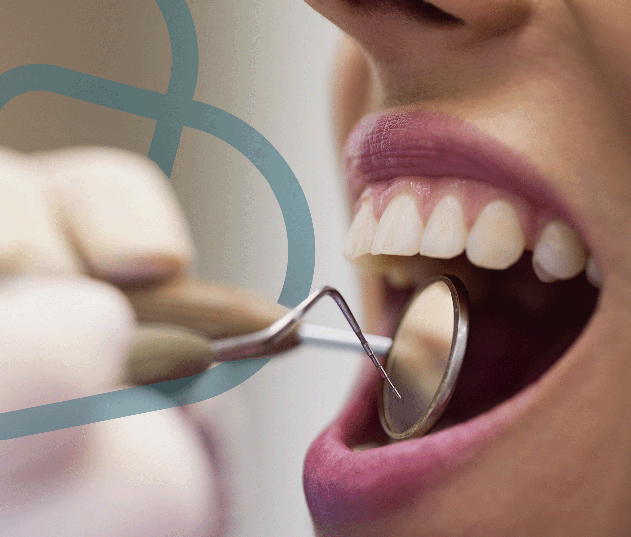 Read more about the article Todas as pessoas precisam extrair o siso? Mitos sobre o “dente do juízo”