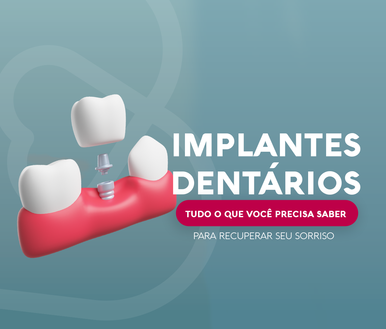 Read more about the article Implantes Dentários: Tudo o que você precisa saber para recuperar seu sorriso